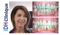 Couronne dentaire Hongrie avis 10 couronnes zircone - clinique iDH Budapest