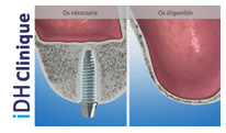 Animation explicative sinus-lift comblement sinusien - clinique iDH Budapest